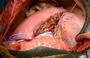 Donor liver after division