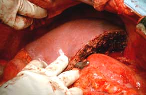 Normal looking liver after transplantation into recipient