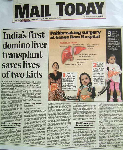 India's First domino liver transplant saves lives of two kids 