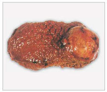 Liver Cirrhosis Treatments,Liver Cirrhosis Symptoms,Child Liver Cirrhosis India