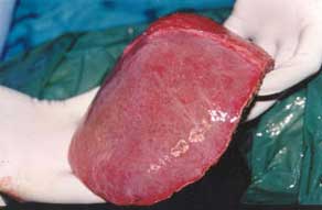  One half of donor liver removed for transplantation into recipient