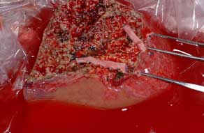 Donor liver prepared for transplant by bench surgery