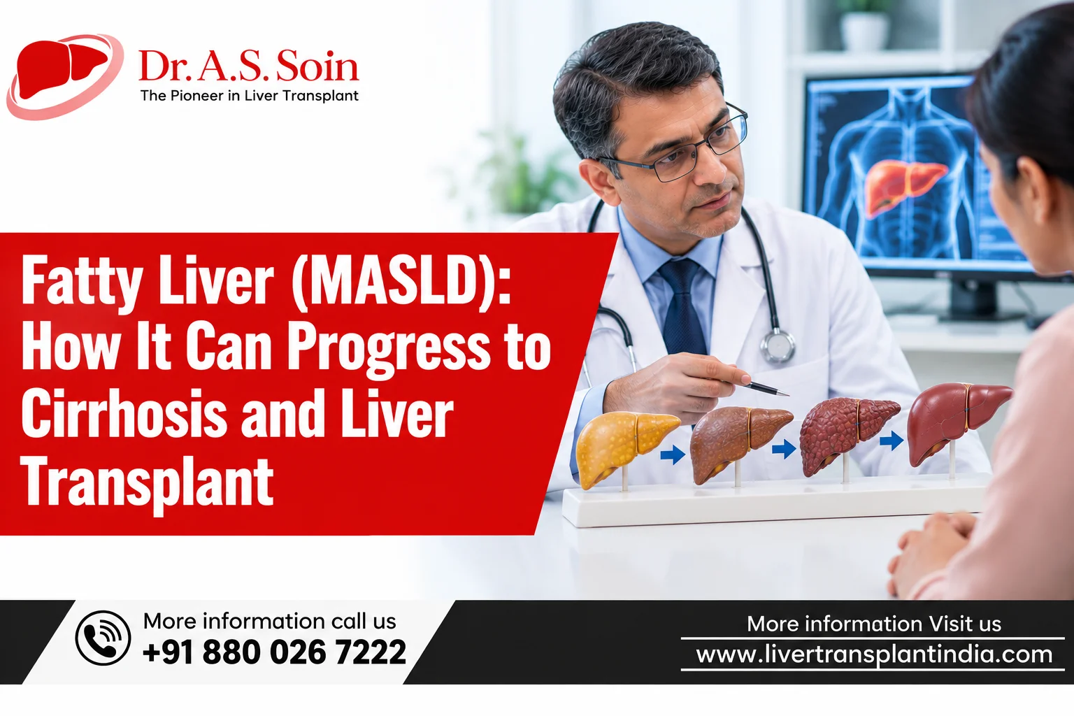 Fatty Liver (MASLD): How It Can Progress to Cirrhosis and Liver Transplant