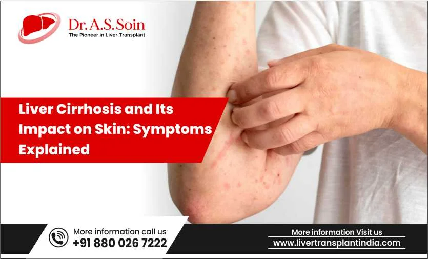 Liver Cirrhosis and Its Impact on Skin: Symptoms Explained