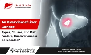 liver cancer types causes and risk factors