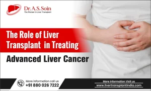 The Role of Liver Transplant in Treating Advanced Liver Cancer