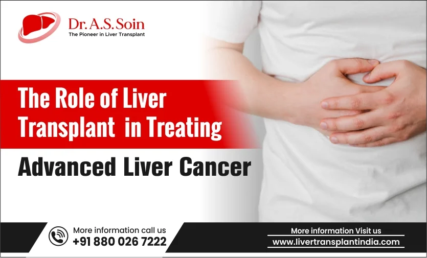 The Role of Liver Transplant in Treating Advanced Liver Cancer